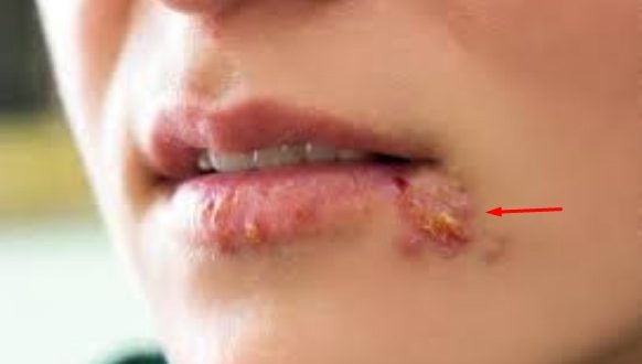 herpes-foto