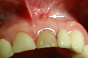 Fistula