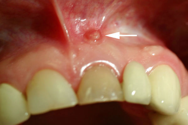 Fistula