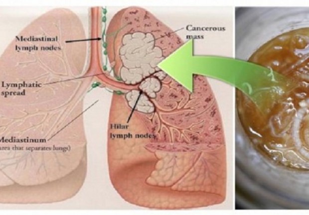 cancer-690x480-620x431