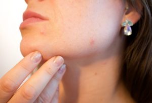 acne-1606765_960_720-660x450