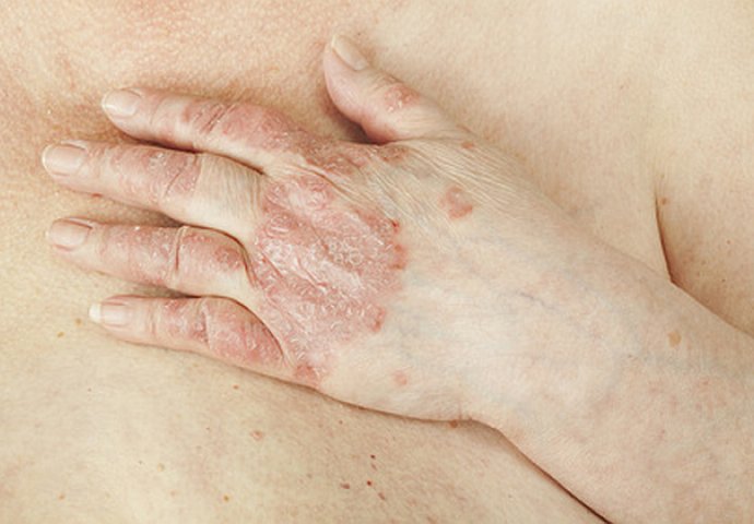 psoriaza