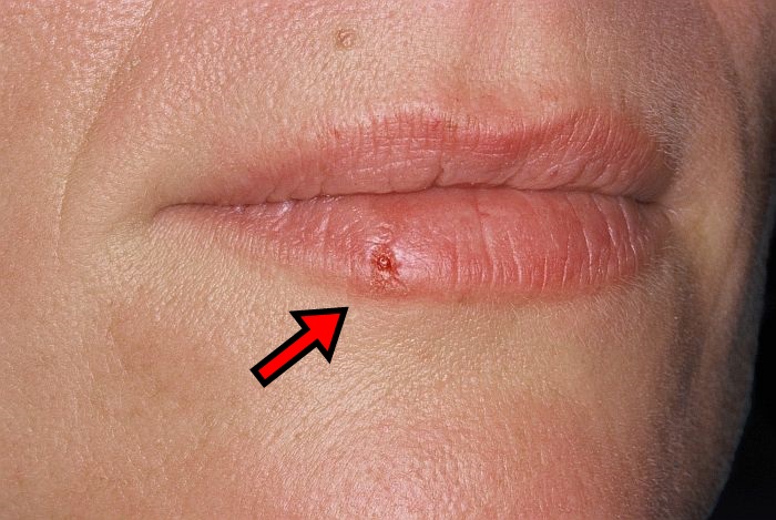 herpes (1)