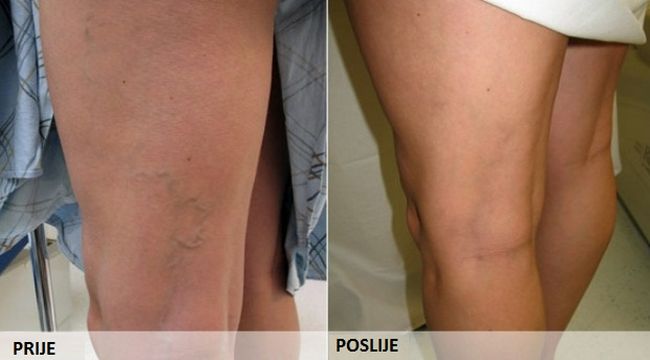prosirene-vene